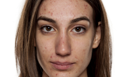 Why do you get adult acne